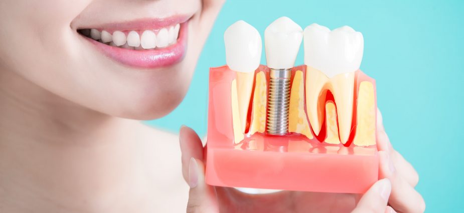 New Dental Implants New Dental Implants