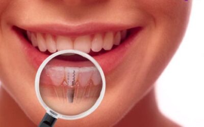 Affordable, High-Quality Dental Implants in Wellington Point