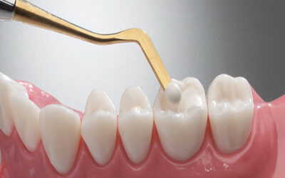 Wellington Point Dental Guide – How Long Can You Expect A Dental Filling To Last?