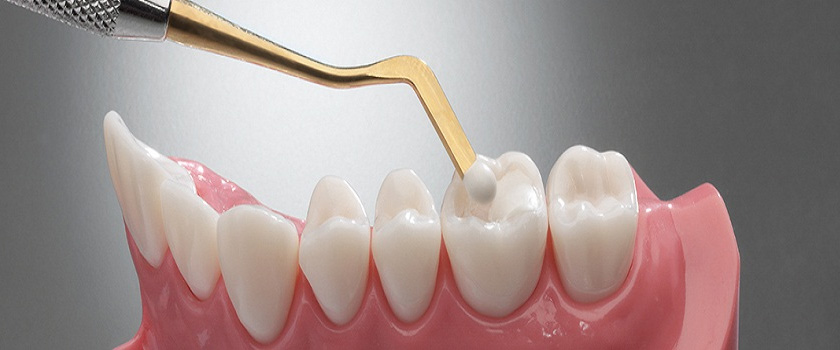 Wellington Point Dental Guide – How Long Can You Expect A Dental Filling To Last?