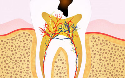 Dentist Wellington Point Guide : What Are the Signs that You Need Root Canal Treatment