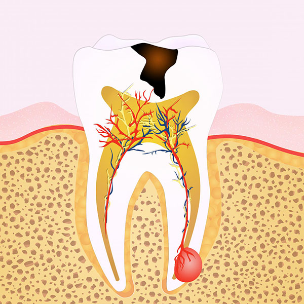 Dentist Wellington Point Guide : What Are the Signs that You Need Root Canal Treatment