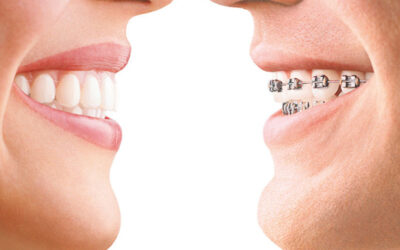 Dentist Wellington Point Guide : Top 3 Most Popular Braces Options For Adults