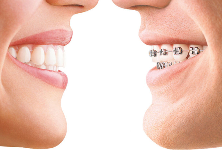 Dentist Wellington Point Guide : Top 3 Most Popular Braces Options For Adults