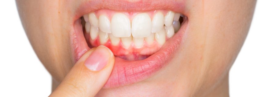 Dentist Wellington Point Guide: Gum Disease – The “Cure” Is Treatment, Then Prevention