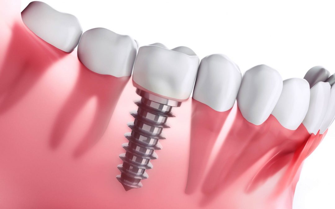 How Much do Dental Implants Cost in Capalaba, Wellington Point?