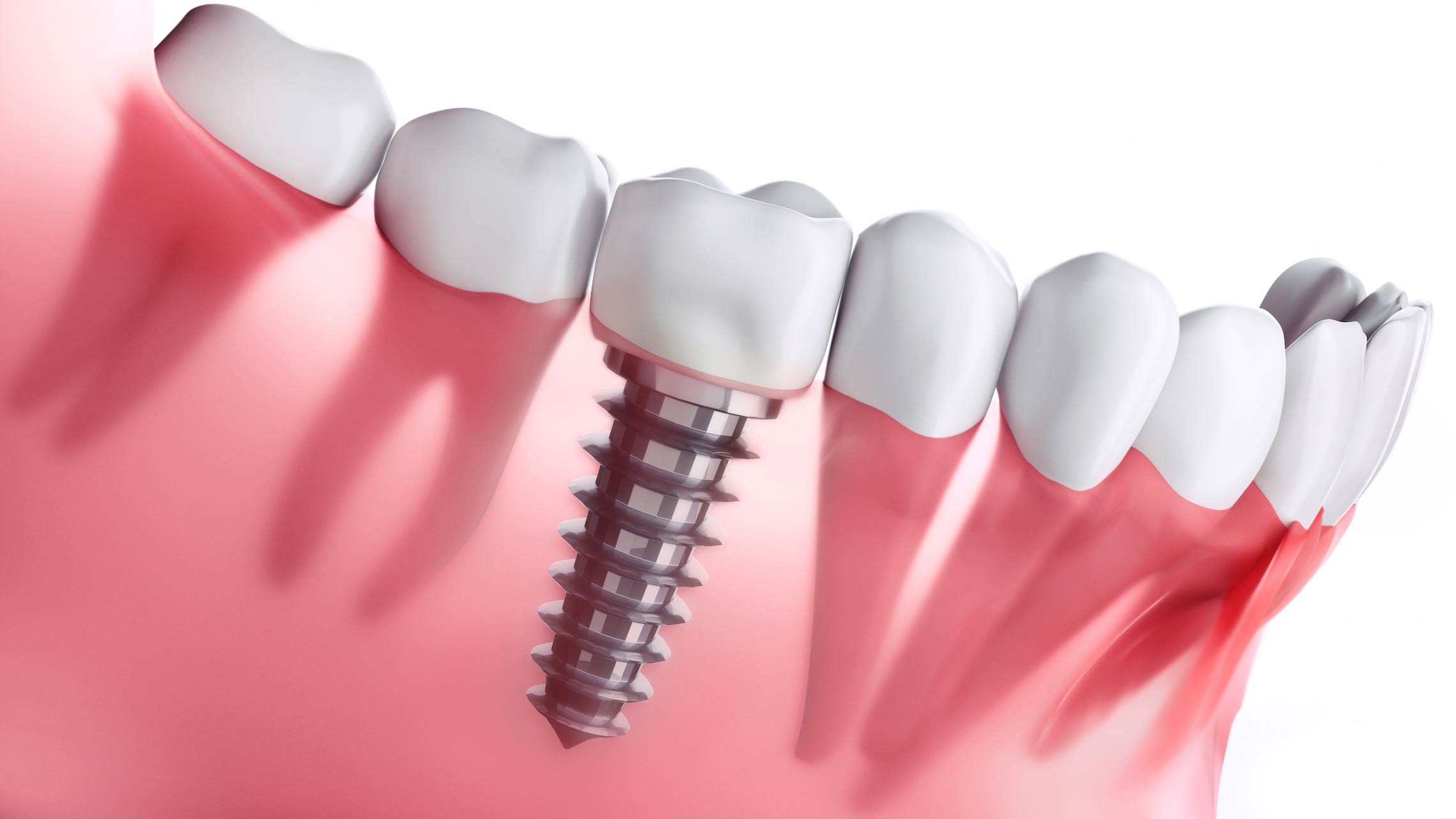 dental implants cost in capalaba, Wellingtonpoint dental implants cost in capalaba, Wellingtonpoint