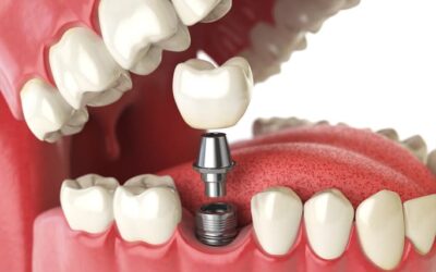5 Reasons to Consider Dental Implants- Dentist Wellington Point Guide