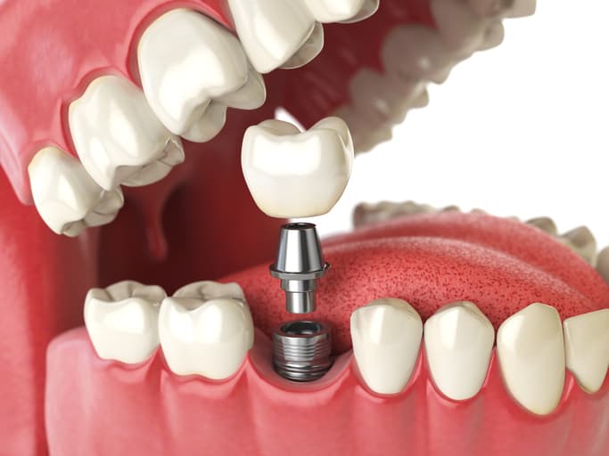 5 Reasons to Consider Dental Implants- Dentist Wellington Point Guide