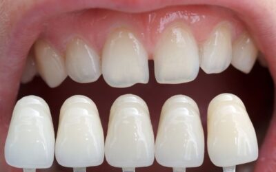 Find Quality Dental Veneers in Wellington Point & Capalaba