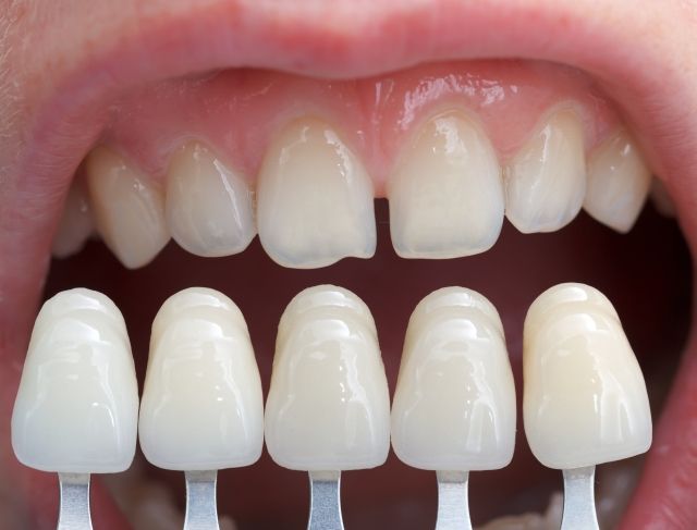 Find Quality Dental Veneers in Wellington Point & Capalaba