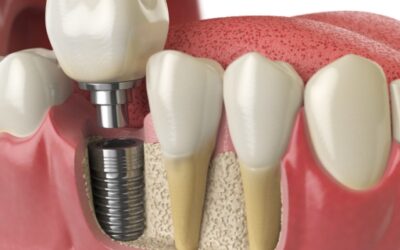 How Long Does the Dental Implant Process Take?