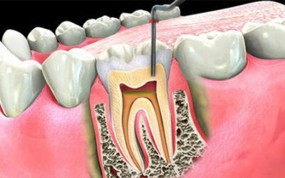 Is Root Canal Treatment Painful?