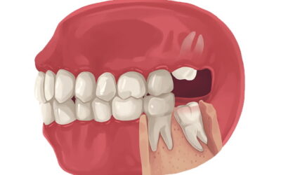 Are There Any Side Effects Of Removing Wisdom Teeth?