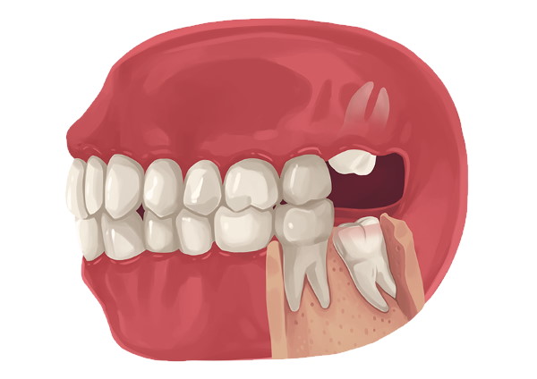 Are There Any Side Effects Of Removing Wisdom Teeth?