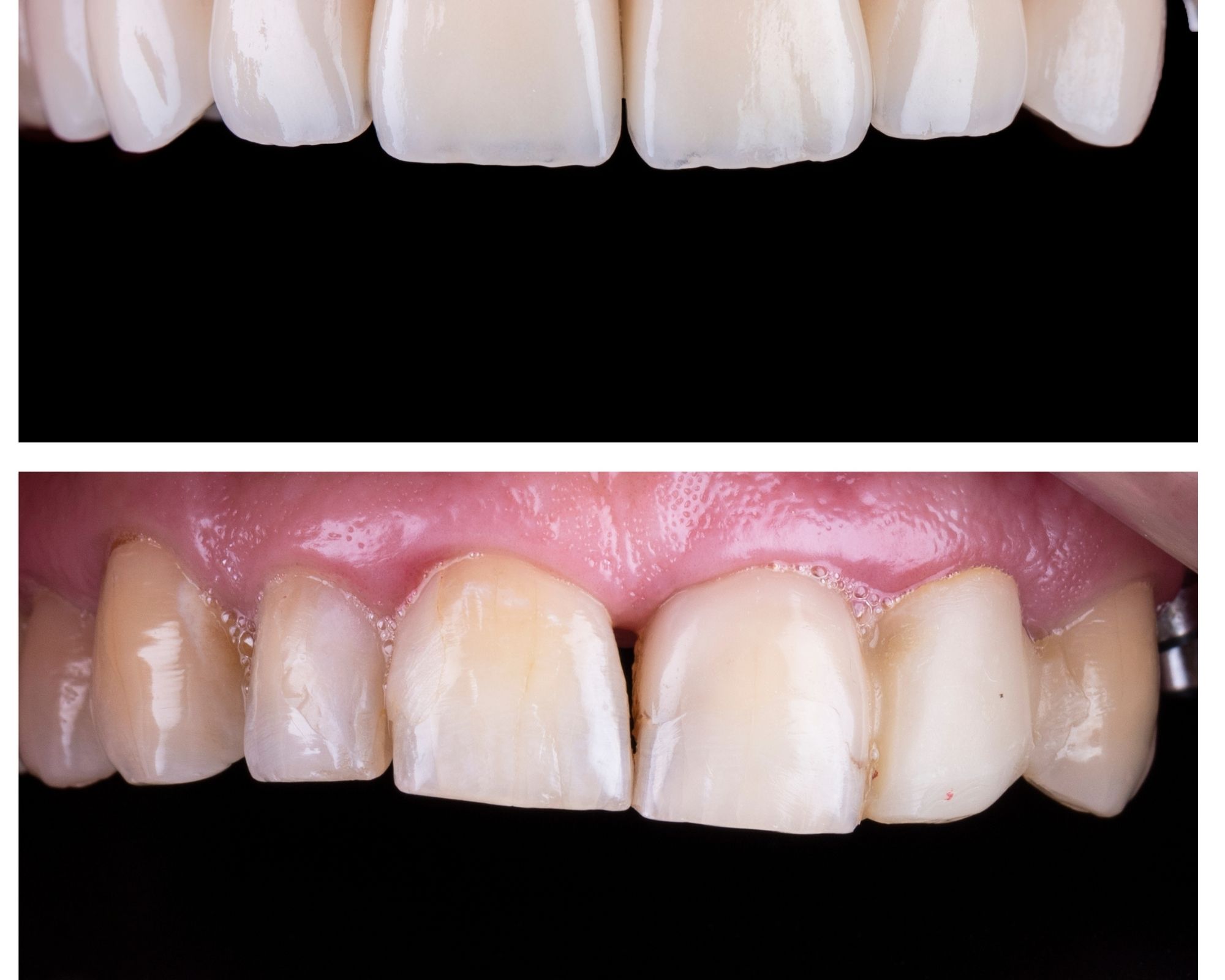5 Great Tips to Look After Your Porcelain Veneers 5 Great Tips to Look After Your Porcelain Veneers