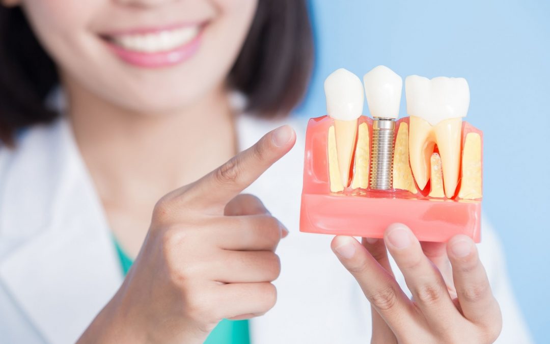 What is the Cost and Procedure for a Single Tooth Dental Implant?