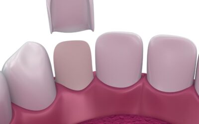Do I need to Straighten my Teeth before Getting Veneers