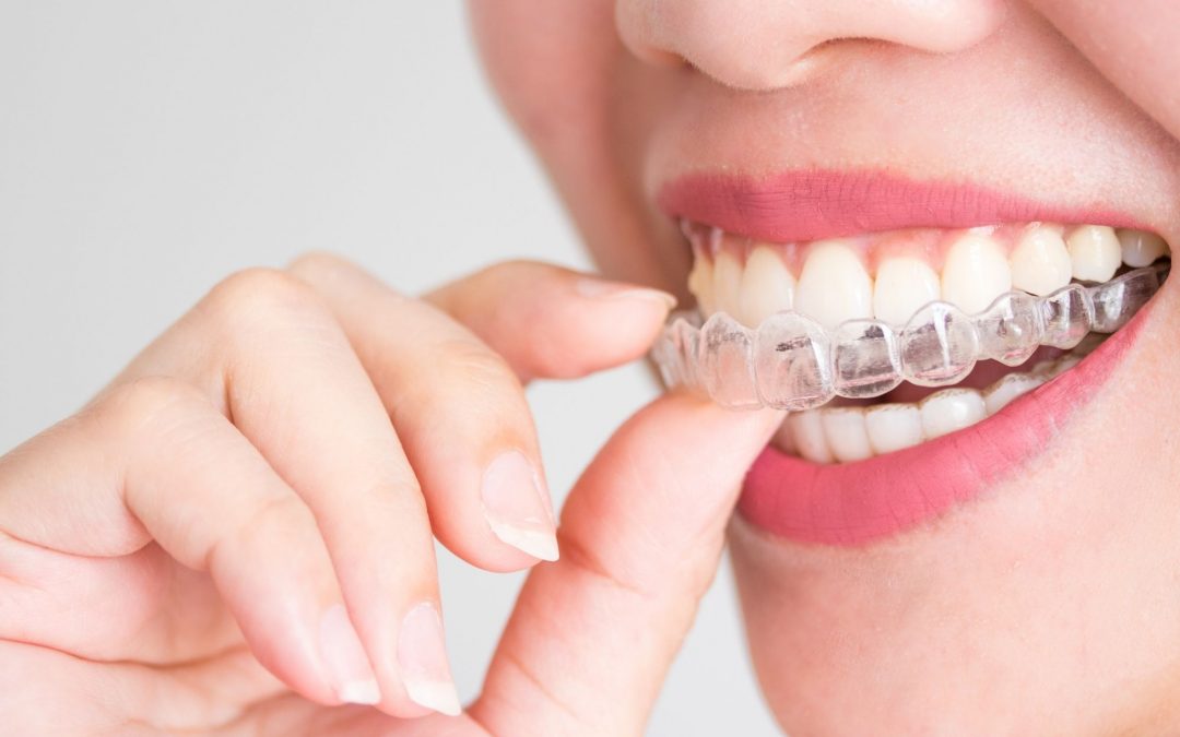 Invisalign or Braces- Which One Is Better