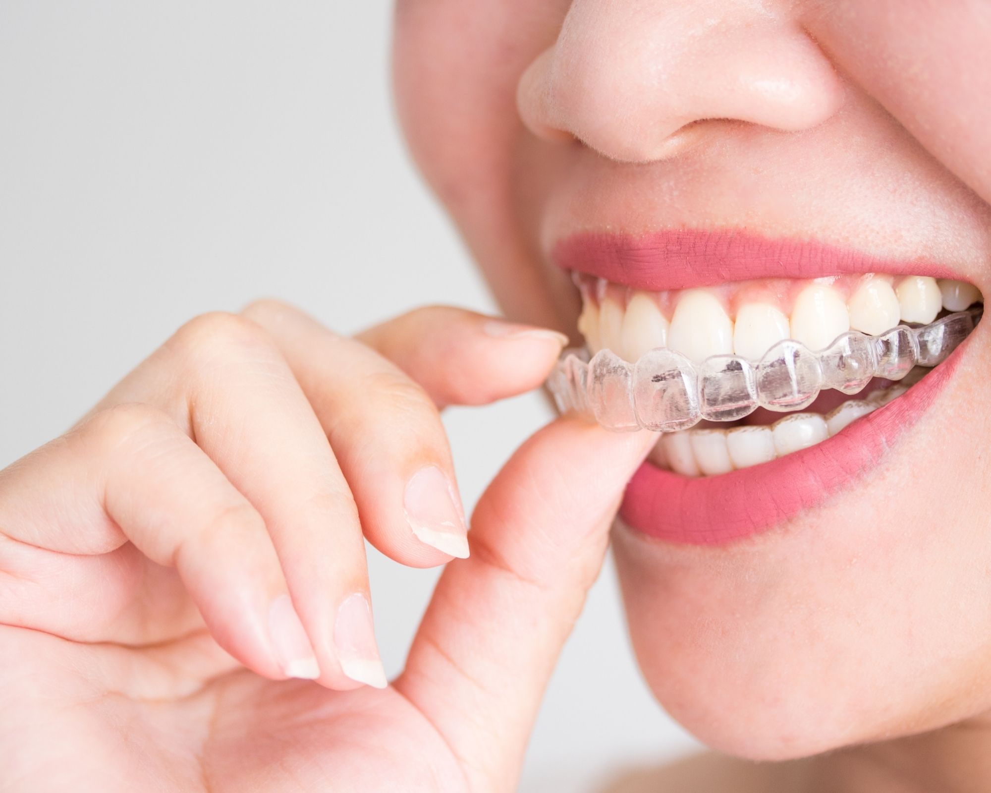 Invisalign or Braces- Which One Is Better Invisalign or Braces- Which One Is Better