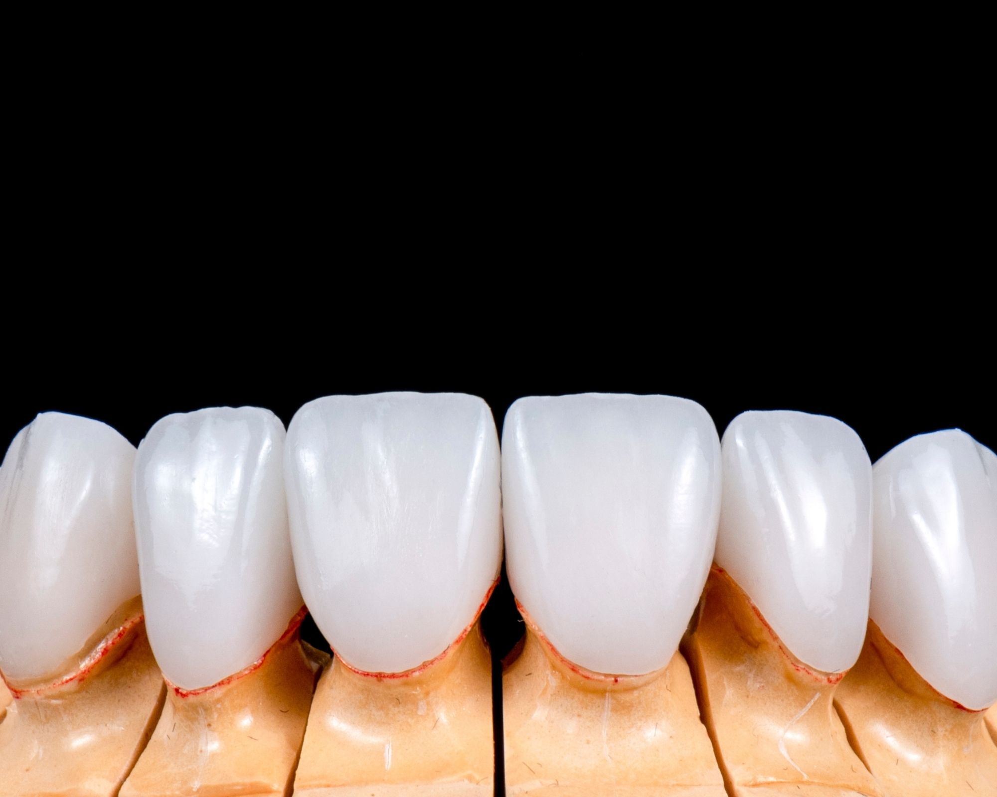 Veneers Vs Crowns- Which One Is Better For You Veneers Vs Crowns- Which One Is Better For You