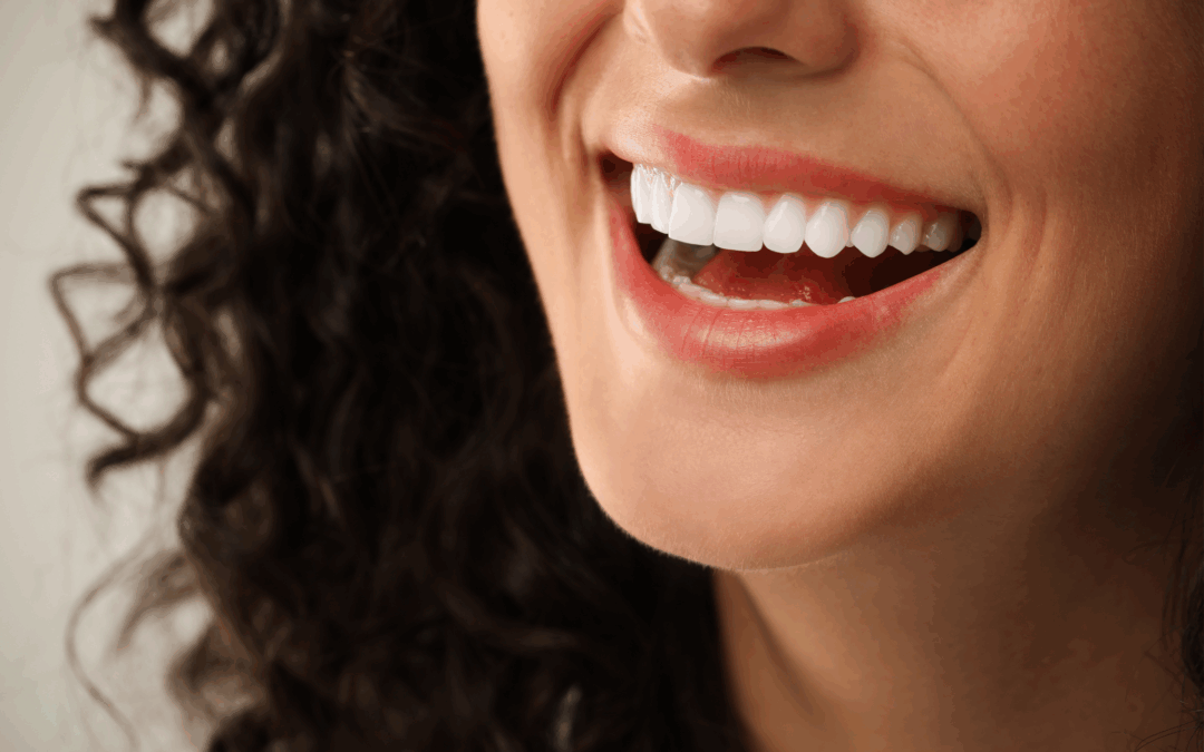 Composite Veneers in Wellington Point – How Effective It Is