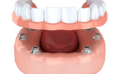 Treating Missing Teeth with All-on-4 in Wellington Point