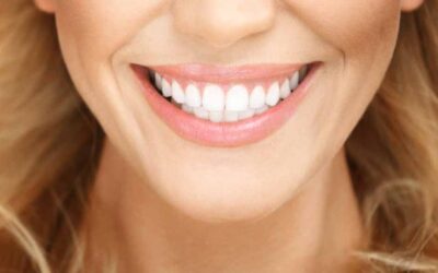 How to look after your composite resin veneers in Wellington Point –5 tips