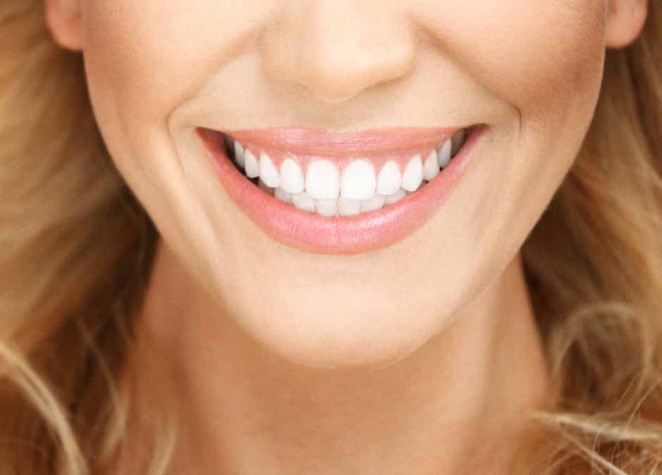 How to look after your composite resin veneers in Wellington Point –5 tips