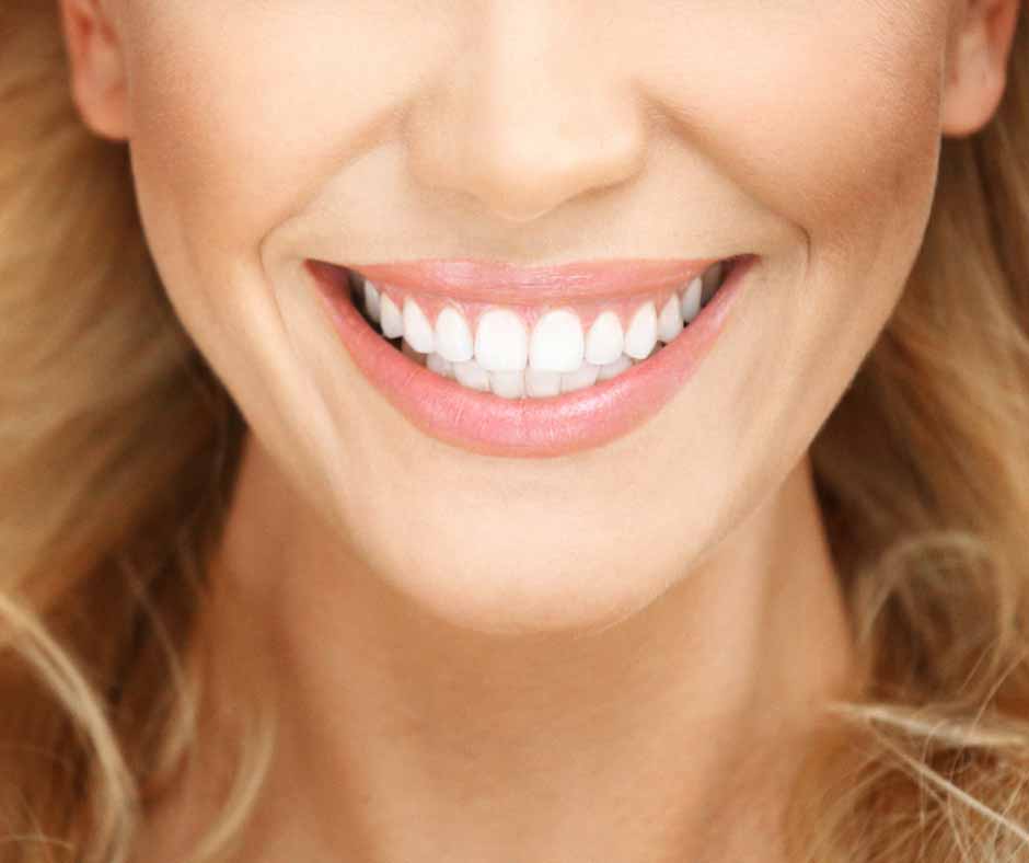 How to look after your composite resin veneers How to look after your composite resin veneers