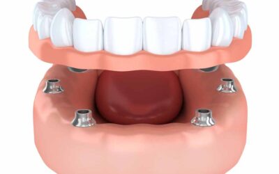 Is it Painful to Get All-on-4 Implants in Wellington Point