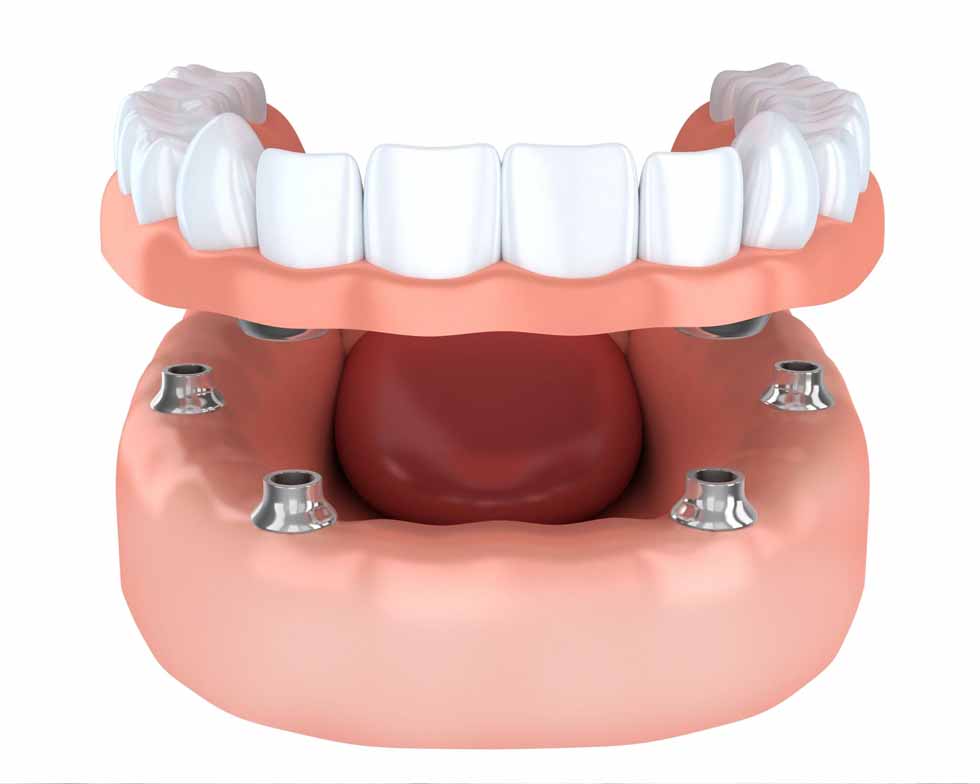 Is it Painful to Get All-on-4 Implants Is it Painful to Get All-on-4 Implants