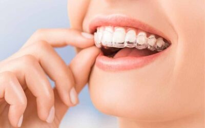 What Foods Should I Avoid During Invisalign Treatment in Wellington Point