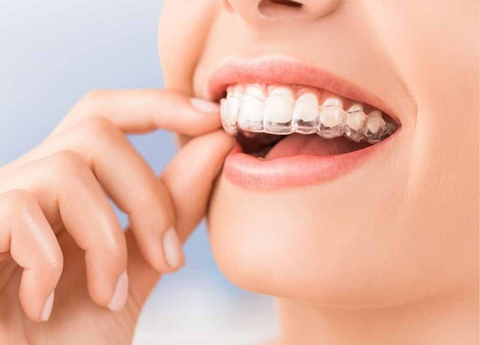 What Foods Should I Avoid During Invisalign Treatment