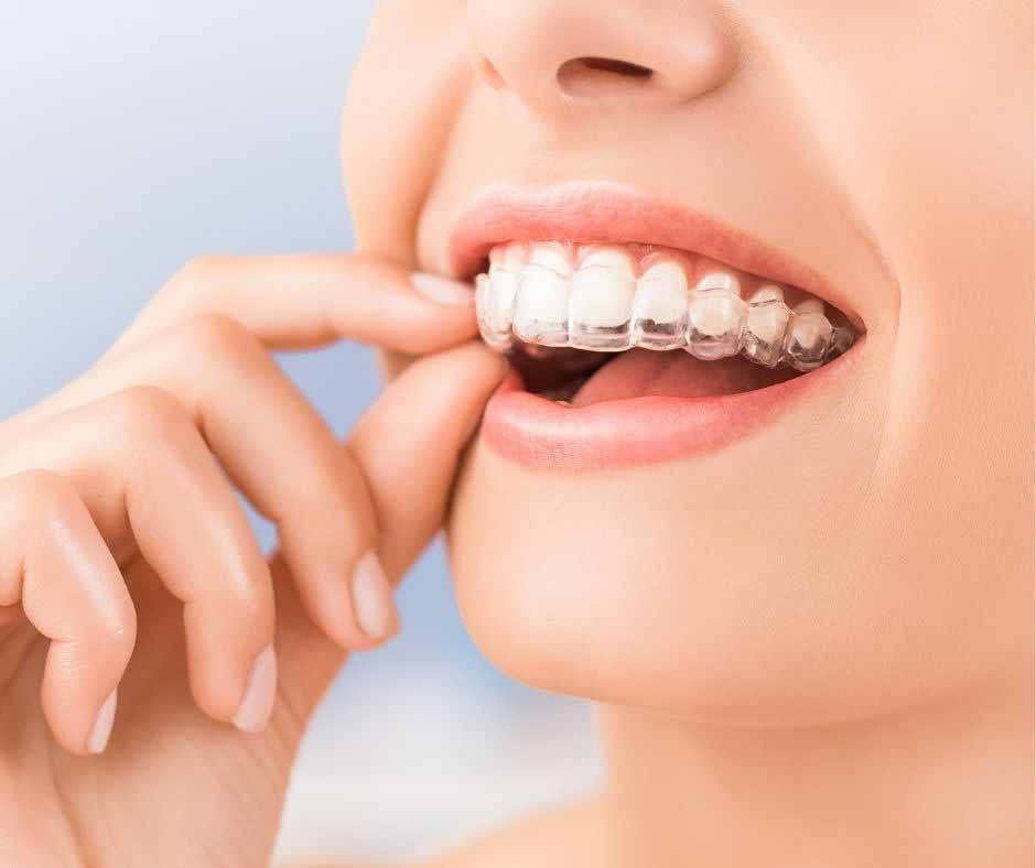 Avoid During Invisalign Treatment Avoid During Invisalign Treatment