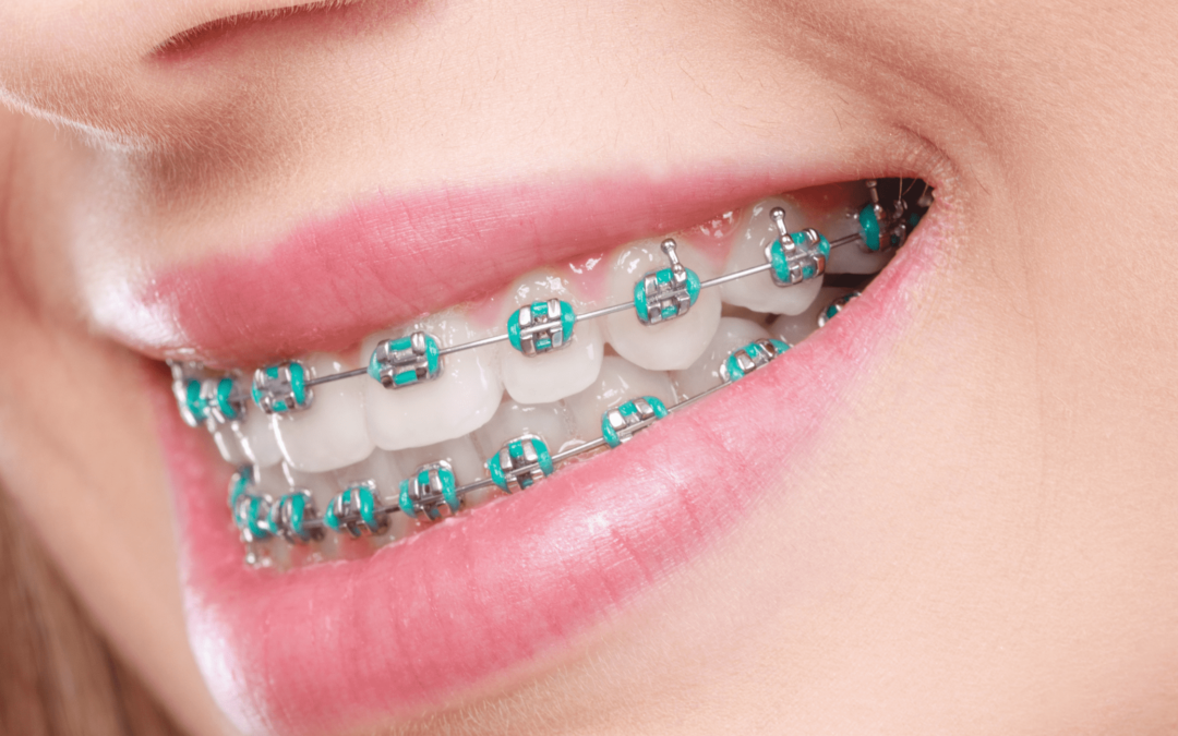 The Benefits of Braces: Why Choose Wellington Point Dental for Your Orthodontic Care