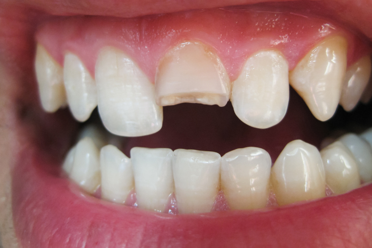 Tooth Repair In Birkdale Tooth Repair In Birkdale