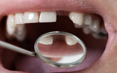Missing Teeth Solutions – Wellington Point & Alexandra Hills