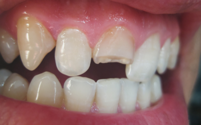 Broken Tooth? Expert Dental Care in Alexandra Hills