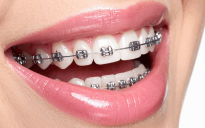 Straighten Your Smile with Confidence in Birkdale