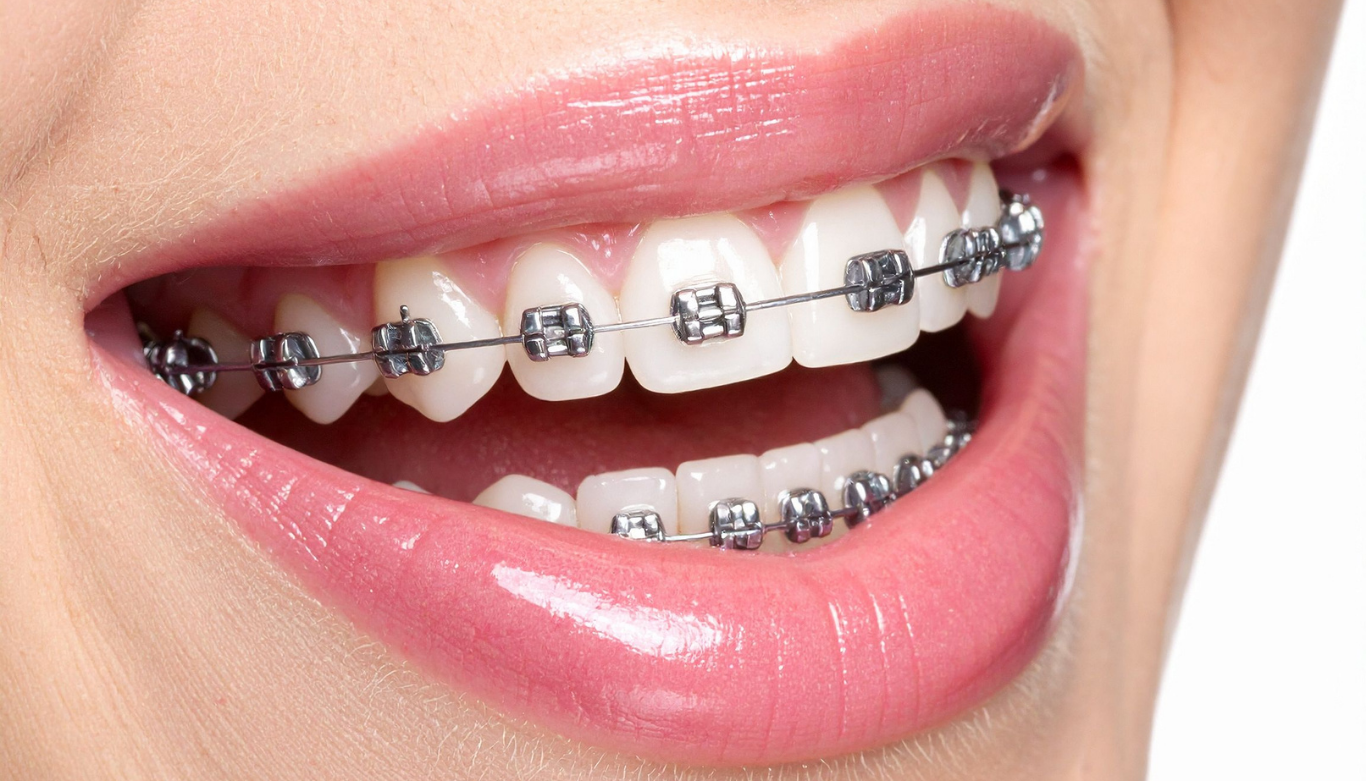 smiling patient with braces from wellington point dental smiling patient with braces from wellington point dental