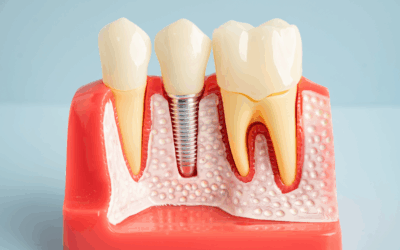Dental Implants Birkdale: Restore Your Smile with Confidence