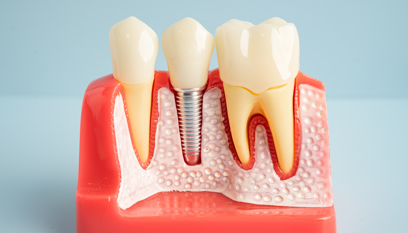dental-implant-wellington-point-dental