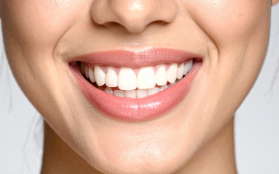 Teeth Whitening Options in Alexandra Hills: Which is Right for You?